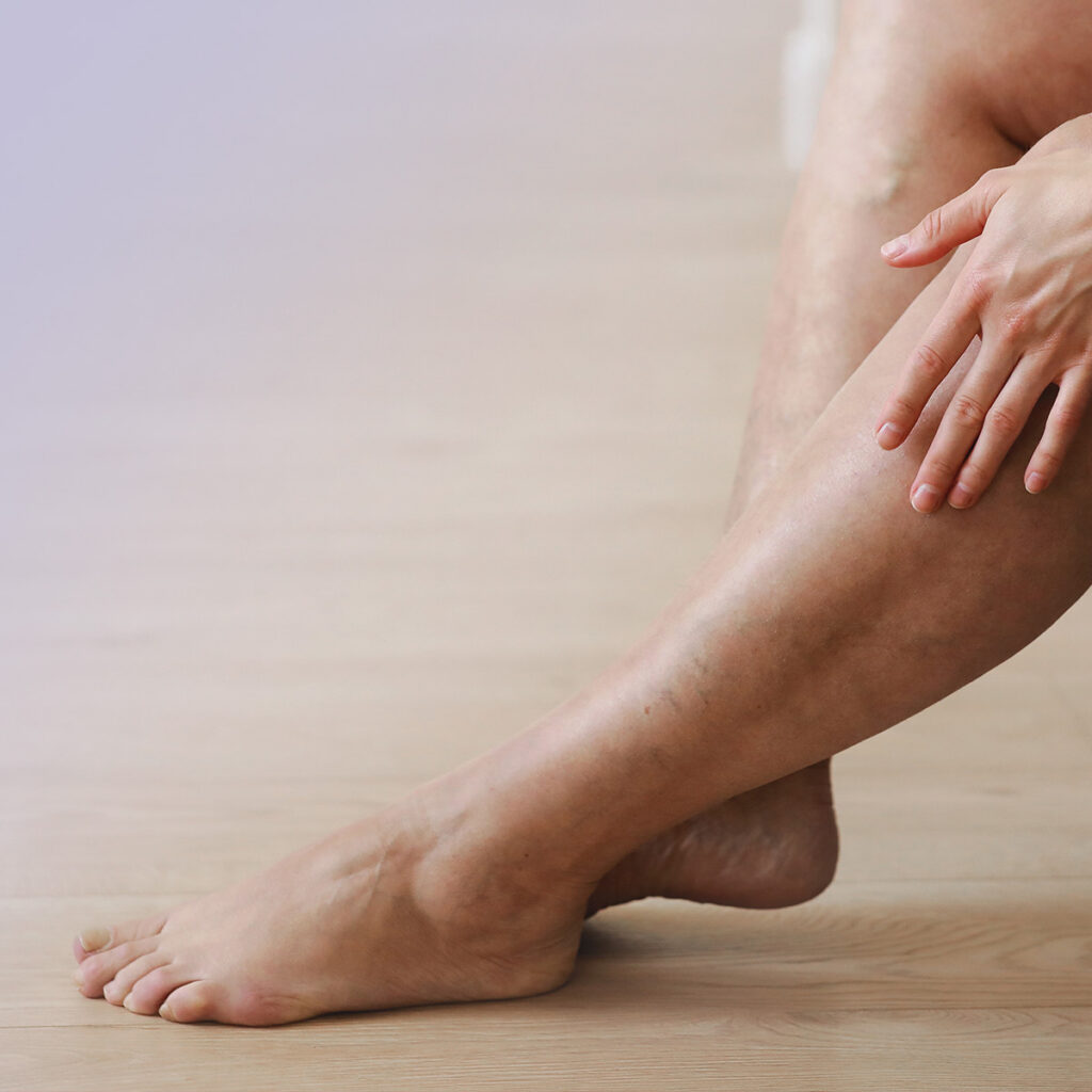 womans legs with veins