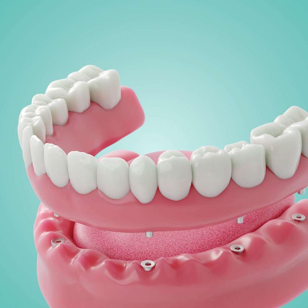 full mouth dental implant diagram