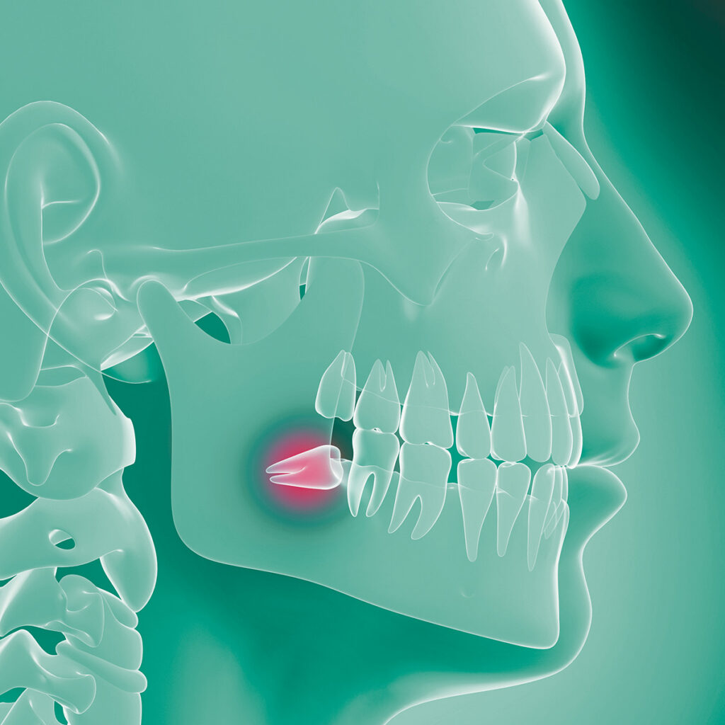 Wisdom tooth pain