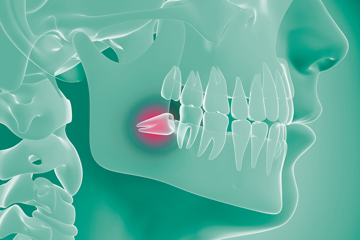 wisdom tooth removal