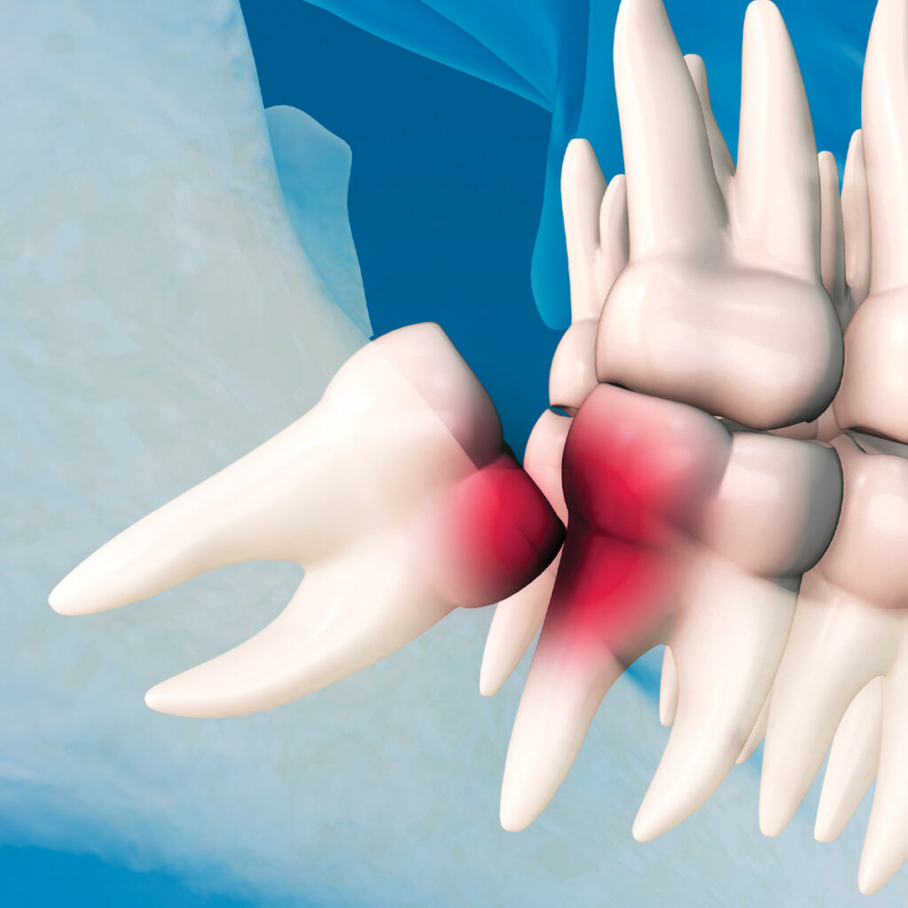 impacted wisdom tooth